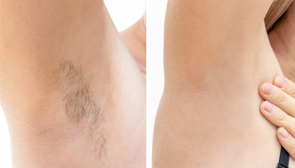 Semiconductor-Laser-Hair-Removal-ODM-Kit